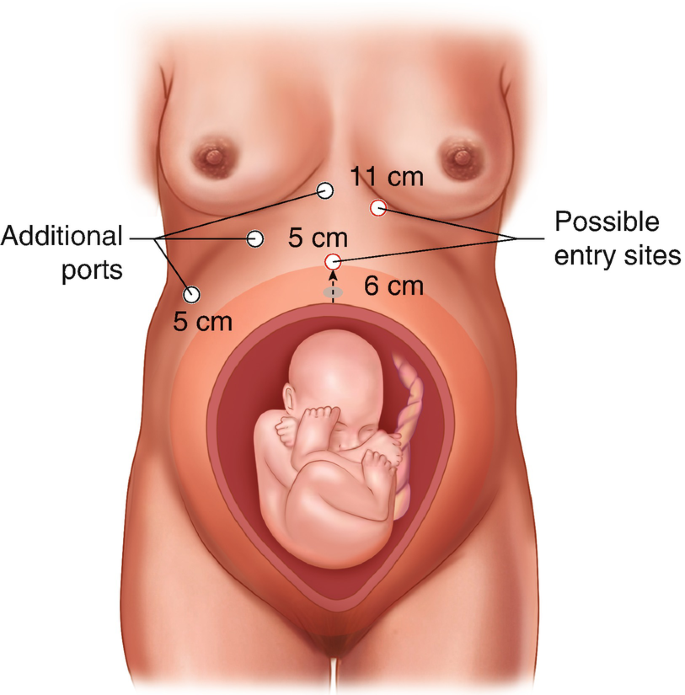 Laparoscopy In Pregnancy